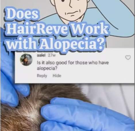 Does HairReve work with Alopecia?